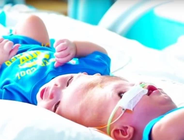 Σιαμαία δίδυμα διαχωρίστηκαν έπειτα από επέμβαση 50 ωρών (βίντεο-φωτο)